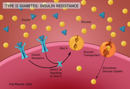Type II Diabetes Poster Print by Monica Schroeder/Science Source - Item # VARSCIBY4078