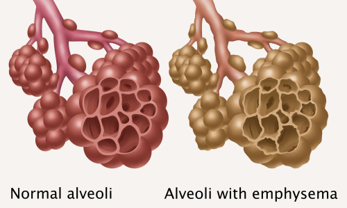 Normal vs. Emphysematous Alveoli Poster Print by Gwen Shockey/Science Source - Item # VARSCIBZ3639