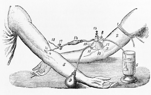 Blood Transfusion, c. 1876 Poster Print by Science Source - Item # VARSCIJA0947