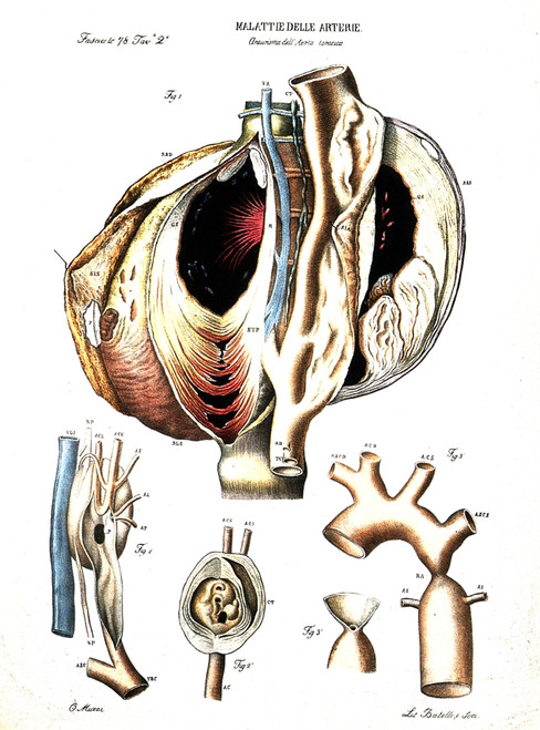 Diseased Artery, Aneurism of the Aorta Poster Print by Science Source - Item # VARSCIJB6894