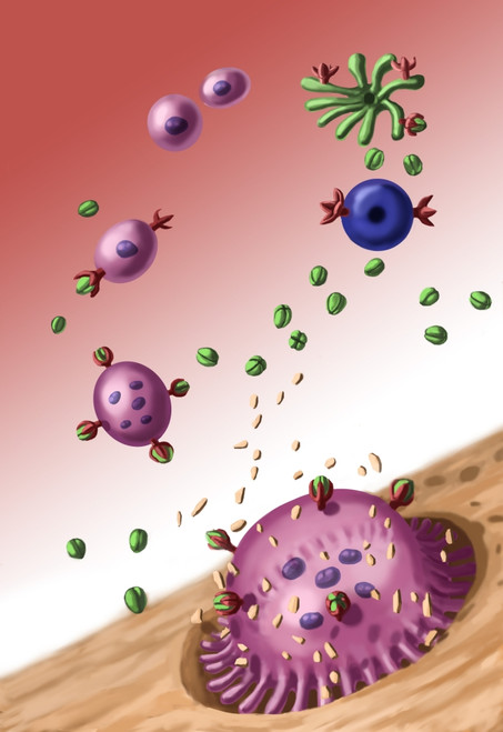 Bone Resorption Poster Print by Spencer Sutton/Science Source - Item # VARSCIBW5678