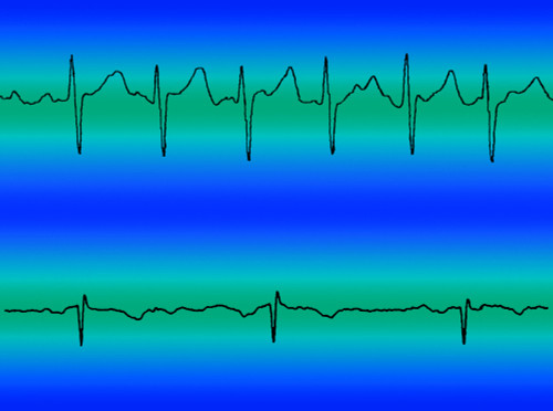 Atrial Fibrillation & Normal Heart Beat Poster Print by Science Source - Item # VARSCIBW6630