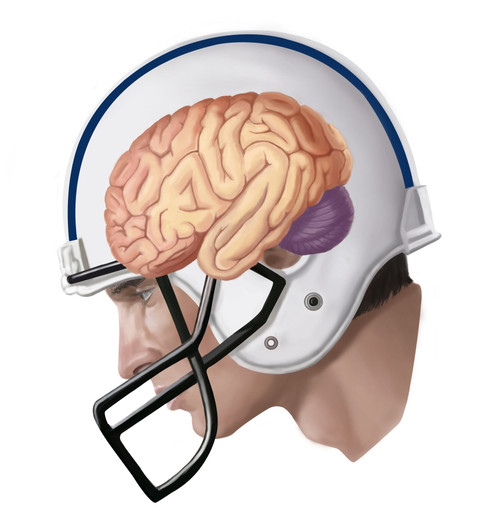 Concussion Poster Print by Spencer Sutton/Science Source - Item # VARSCIBV1163