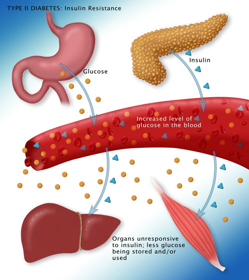 Type II Diabetes Poster Print by Monica Schroeder/Science Source - Item # VARSCIBY4050