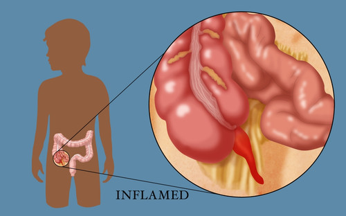 Inflamed Appendix Poster Print by Monica Schroeder/Science Source - Item # VARSCIBW0186