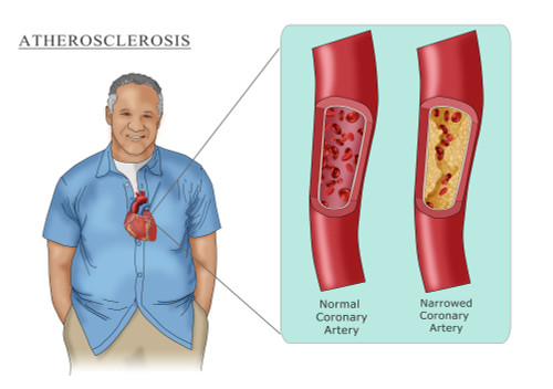 Man with Heart Disease, Illustration Poster Print by Monica Schroeder/Science Source - Item # VARSCIJB7847