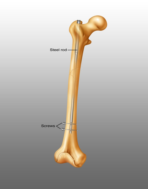 Femur Fracture Repair Poster Print by Gwen Shockey/Science Source - Item # VARSCIJC1514
