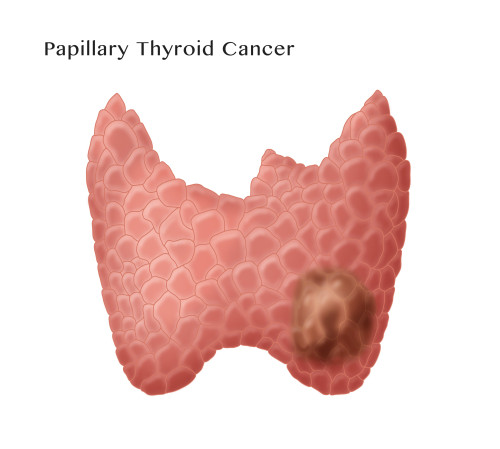 Papillary Thyroid Cancer Poster Print by Monica Schroeder/Science Source - Item # VARSCIJC2624
