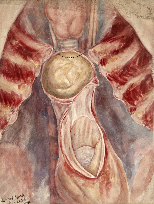 Aneurysm, Aortic Arch, Illustration, 1896 Poster Print by Science Source - Item # VARSCIJA1809