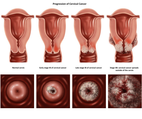 Cervical Cancer Poster Print by Gwen Shockey/Science Source - Item # VARSCIBW1337
