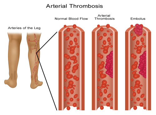 Leg Blood Clots Poster Print by Gwen Shockey/Science Source - Item # VARSCIBY1904 Leg Blood Clots Poster Print by Gwen Shockey/Science Source - Item # VARSCIBY1904