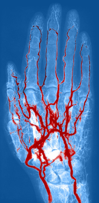 Hand Arteriogram Poster Print by Science Source - Item # VARSCIBN9679