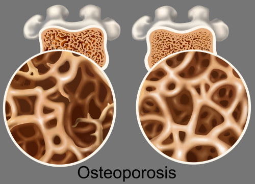 Osteoporotic & Normal Bone Poster Print by Gwen Shockey/Science Source - Item # VARSCIBY3825