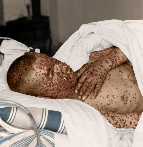 Smallpox Victim Poster Print by Science Source - Item # VARSCIBY4454