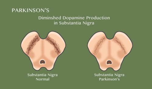 Substantia Nigra & Parkinson's Disease Poster Print by Monica Schroeder/Science Source - Item # VARSCIJC0698