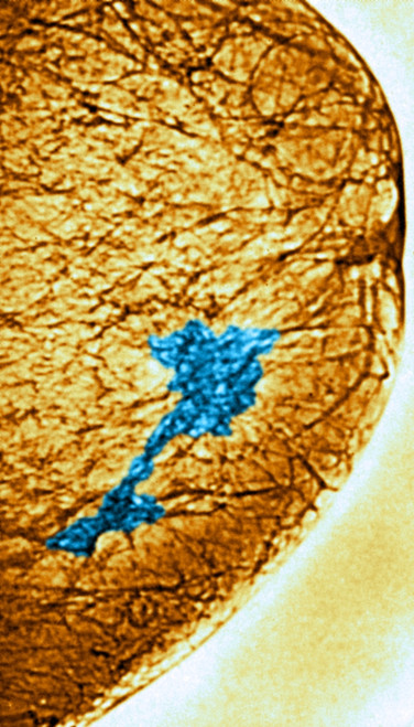 Mammogram Poster Print by Science Source