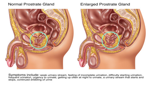 Normal & Enlarged Prostrate Gland, Illustration Poster Print by Gwen Shockey/Science Source - Item # VARSCIJB5104