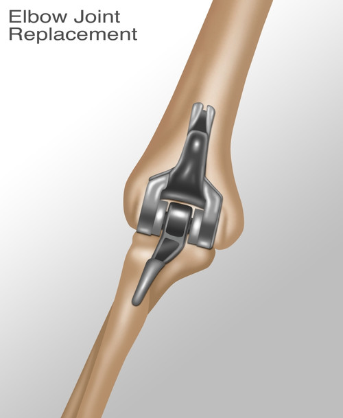 Elbow Joint Replacement, Illustration Poster Print by Gwen Shockey/Science Source - Item # VARSCIJB8463