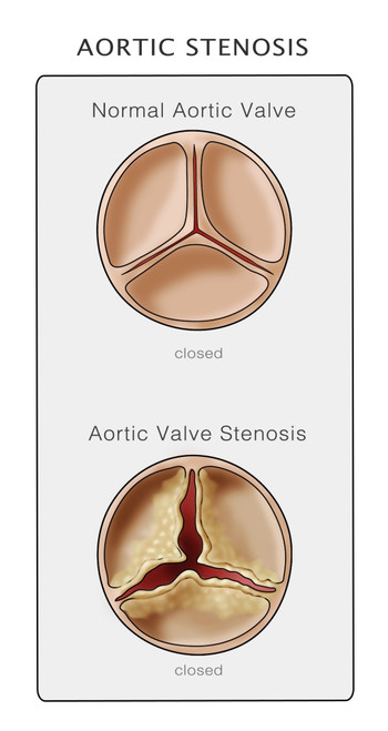 Aortic Valve, Normal & Stenosis, Illustration Poster Print by Monica Schroeder/Science Source - Item # VARSCIJB5278