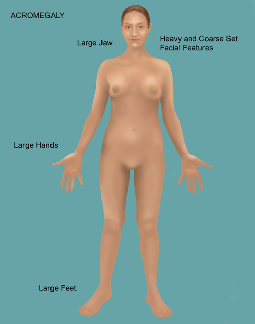 Acromegaly Poster Print by Gwen Shockey/Science Source