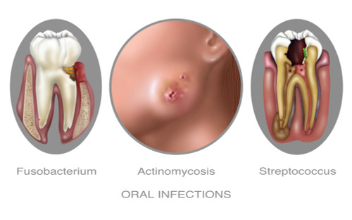 Oral Infections, Illustration Poster Print by Gwen Shockey/Science Source - Item # VARSCIJB3251