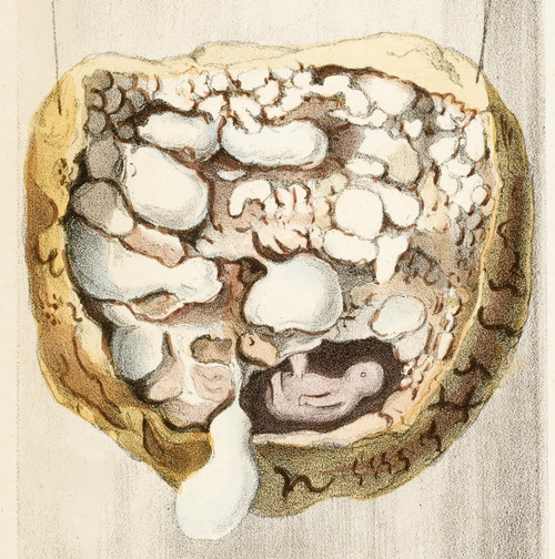 Placenta with Tumors, Illustration, 1836 Poster Print by Science Source - Item # VARSCIJA1796