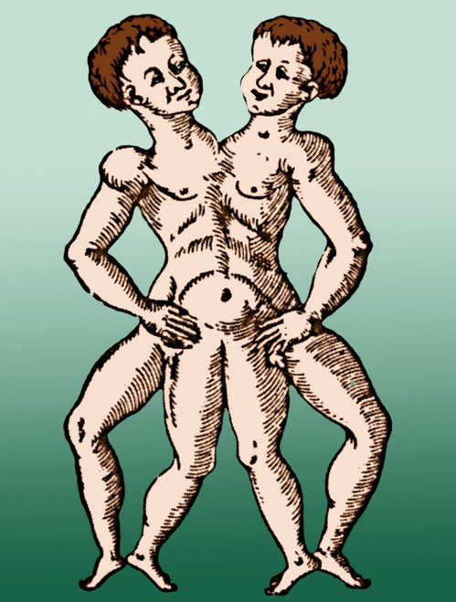 Conjoined Twins, 16th Century Poster Print by Science Source - Item # VARSCIBZ6473