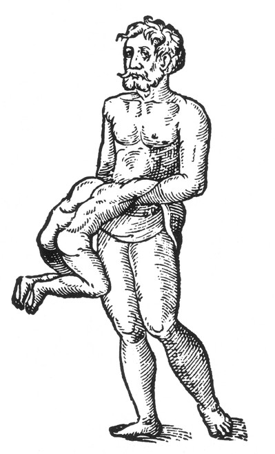 Parasitic Conjoined Twin, 16th Century Poster Print by Science Source - Item # VARSCI9N3006