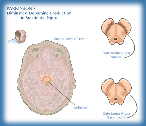 Substantia Nigra & Parkinson's Disease Poster Print by Monica Schroeder/Science Source - Item # VARSCIJC0728