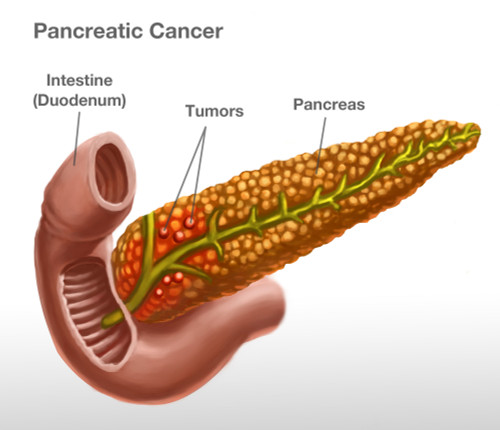 Pancreatic Cancer, Illustration Poster Print by Spencer Sutton/Science Source - Item # VARSCIJB9171