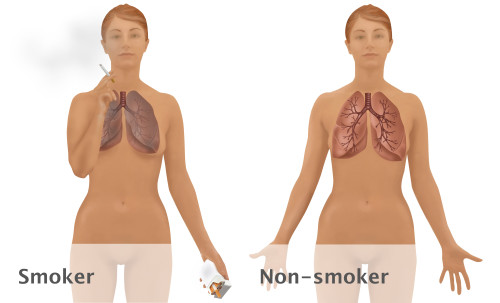 Lungs of Smoker vs. Non-Smoker Poster Print by Gwen Shockey/Science Source - Item # VARSCIBZ3678