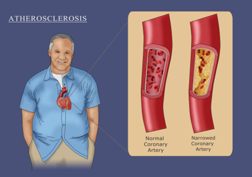 Man with Heart Disease, Illustration Poster Print by Monica Schroeder/Science Source - Item # VARSCIJB7848