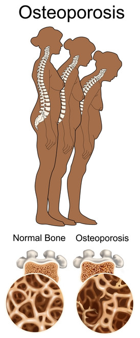 Osteoporosis Poster Print by Gwen Shockey/Science Source