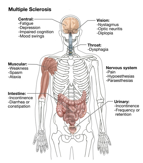Multiple Sclerosis Symptoms Poster Print by Spencer Sutton/Science Source - Item # VARSCIJB9160
