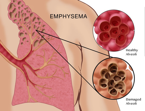 Emphysema Poster Print by Monica Schroeder/Science Source - Item # VARSCIBZ3971