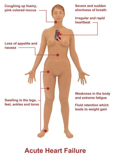 Acute Heart Failure Poster Print by Gwen Shockey/Science Source - Item # VARSCIBZ1714