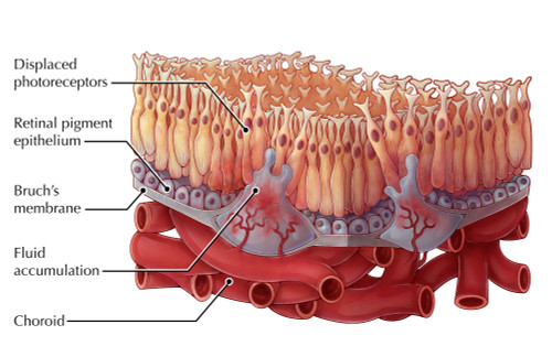 Wet AMD, Illustration Poster Print by Evan Oto/Science Source - Item # VARSCIJA4038