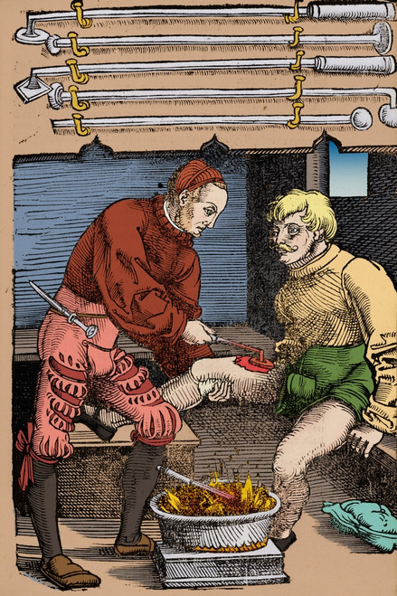 Thigh Cauterization, 16th Century Medicine Poster Print by Science Source - Item # VARSCIJF0654