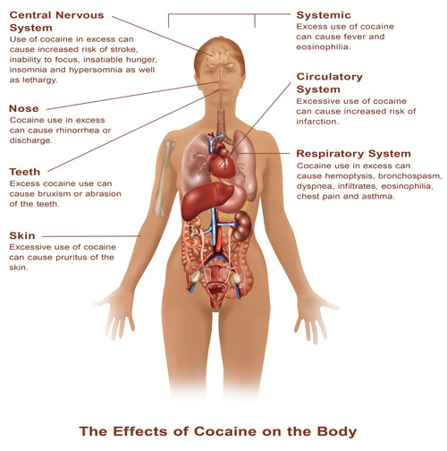 Effects of Cocaine Use Poster Print by Gwen Shockey/Science Source - Item # VARSCIBX8296
