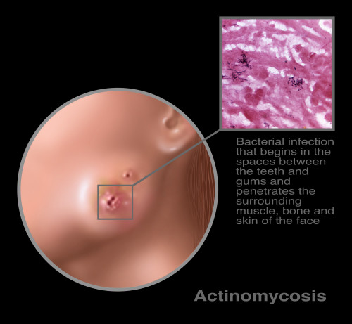 Oral Infection of Actinomycosis Poster Print by Gwen Shockey/Science Source - Item # VARSCIJB3244