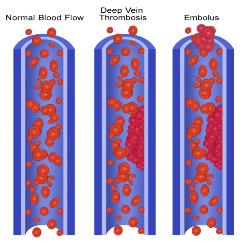 Blood Clots Poster Print by Gwen Shockey/Science Source - Item # VARSCIBY1914 Blood Clots Poster Print by Gwen Shockey/Science Source - Item # VARSCIBY1914