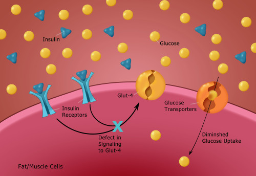 Type II Diabetes Poster Print by Monica Schroeder/Science Source - Item # VARSCIBY4081