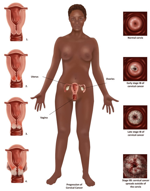 Cervical Cancer Poster Print by Gwen Shockey/Science Source - Item # VARSCIBW1343