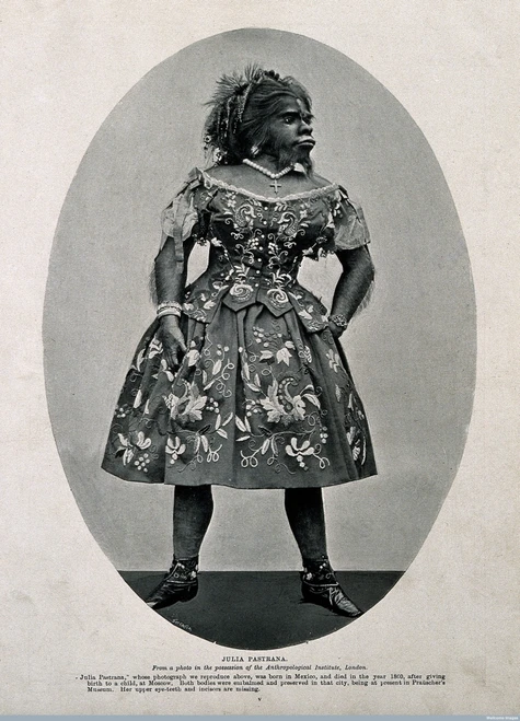 Julia Pastrana, Bearded Lady Poster Print by Science Source
