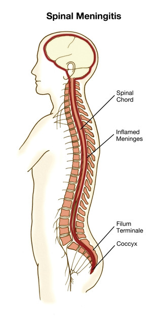 Spinal Meningitis Poster Print by Spencer Sutton/Science Source - Item # VARSCIBZ4334