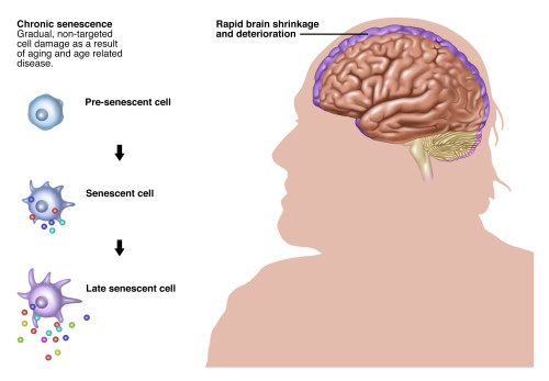 Chronic Senescence and Brain Shrinkage Poster Print by Gwen Shockey/Science Source - Item # VARSCIJC6239