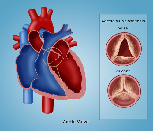 Aortic Valve Stenosis Poster Print by Monica Schroeder/Science Source - Item # VARSCIBY4115