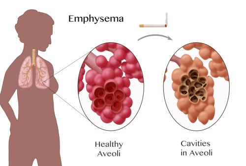 Alveoli Comparison, Emphysema Poster Print by Monica Schroeder/Science Source - Item # VARSCIBZ9029