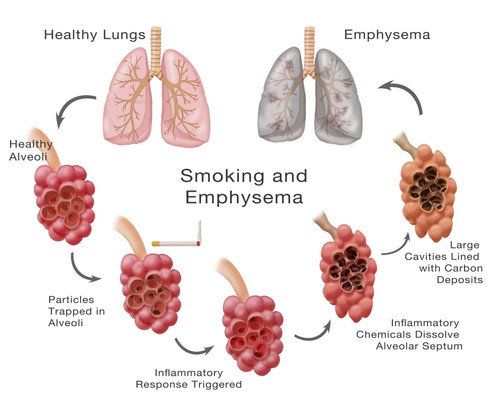 Lung Damage Leading to Emphysema Poster Print by Monica Schroeder/Science Source - Item # VARSCIBZ9022