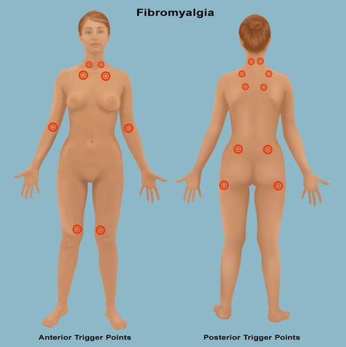 Fibromyalgia Poster Print by Gwen Shockey/Science Source - Item # VARSCIBW7447